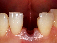 抜歯即時インプラント治療例